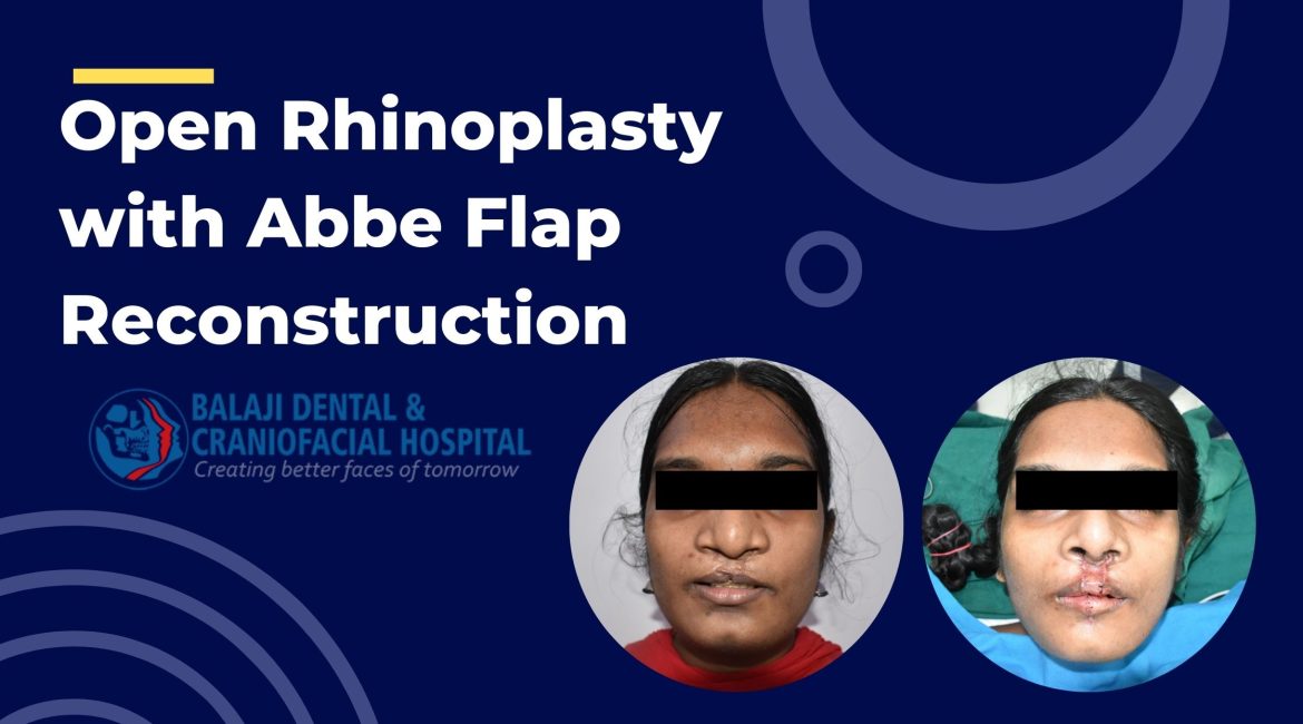 Open Rhinoplasty In India