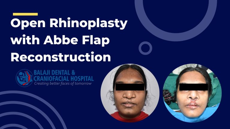 Open Rhinoplasty In India