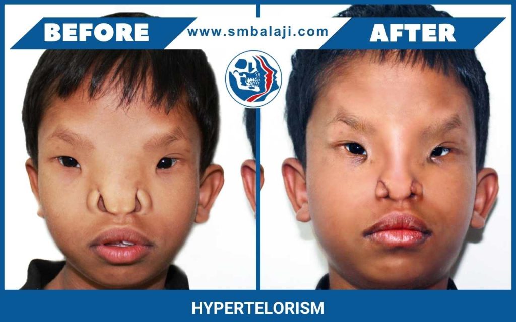 Orbital Hypertelorism, Before And After Surgery