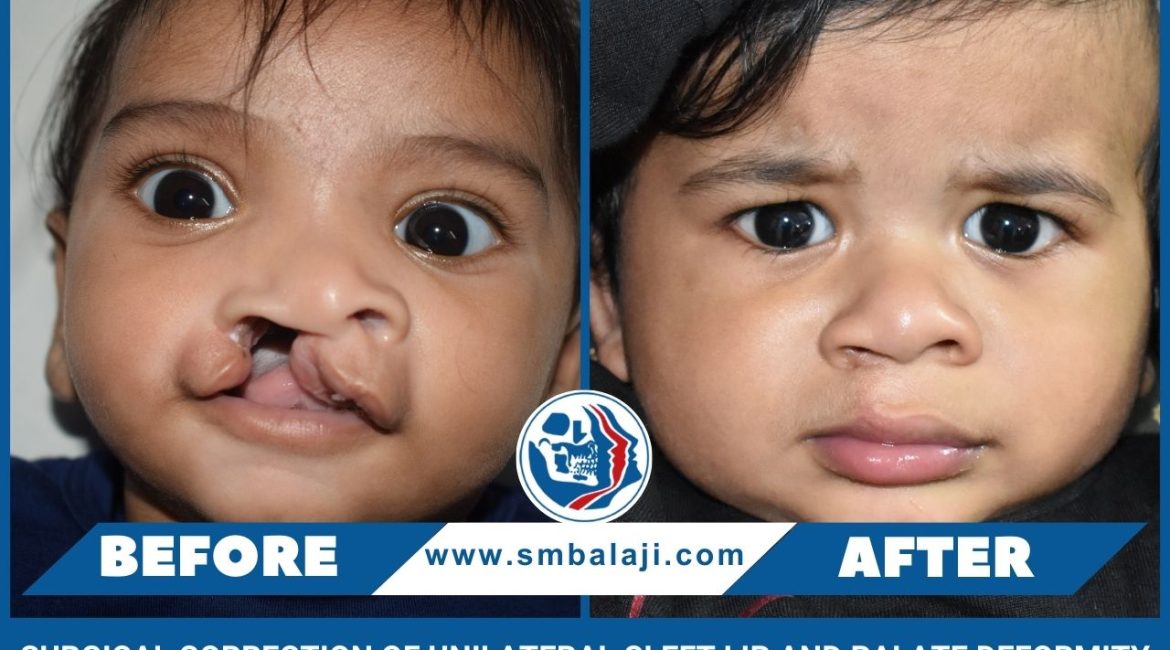 Surgical Correction Of Unilateral Cleft Lip And Palate Deformity