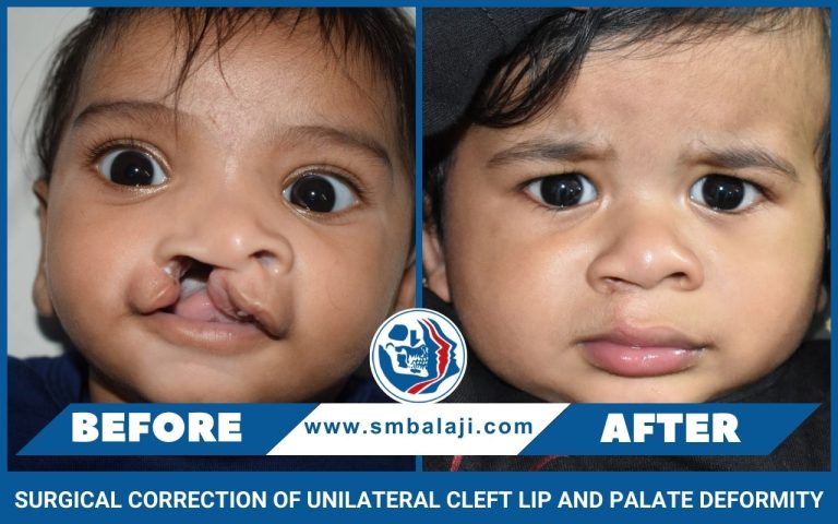 Surgical Correction Of Unilateral Cleft Lip And Palate Deformity