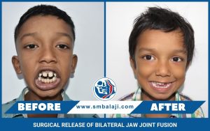 Surgical Release Of Bilateral Jaw Joint Fusion 1