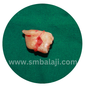 The Extracted Upper Right Third Molar