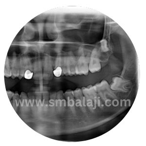 X-Ray Showing Impacted Upper Right And Left Third Molar Teeth