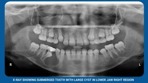 X-Ray Showing Submerged Tooth With Large Cyst In Lower Jaw Right Region