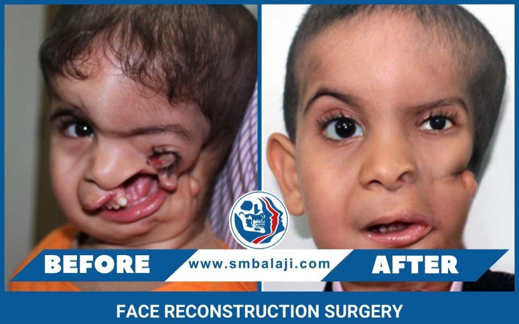 Face Reconstruction Surgery