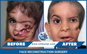 face reconstruction surgery