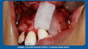 Rhbmp-2 Placed In Bony Defect Avoiding Bone Graft
