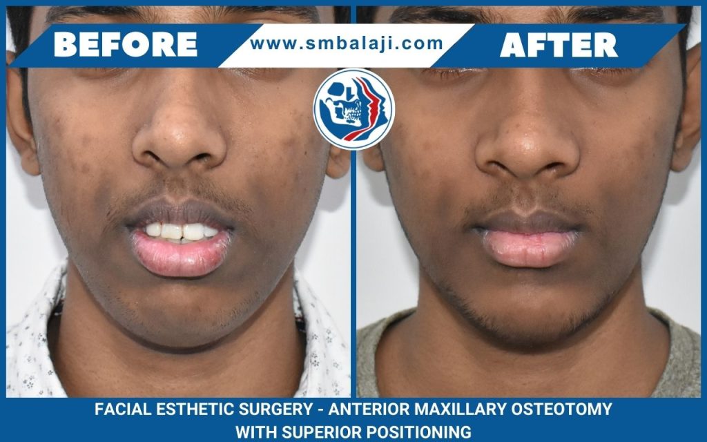 Transforming Smiles: A Journey Through Anterior Maxillary Osteotomy