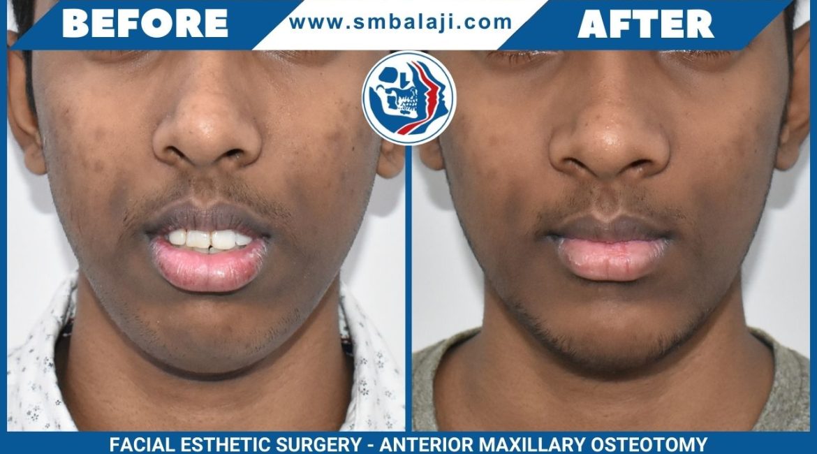 Transforming Smiles: A Journey Through Anterior Maxillary Osteotomy