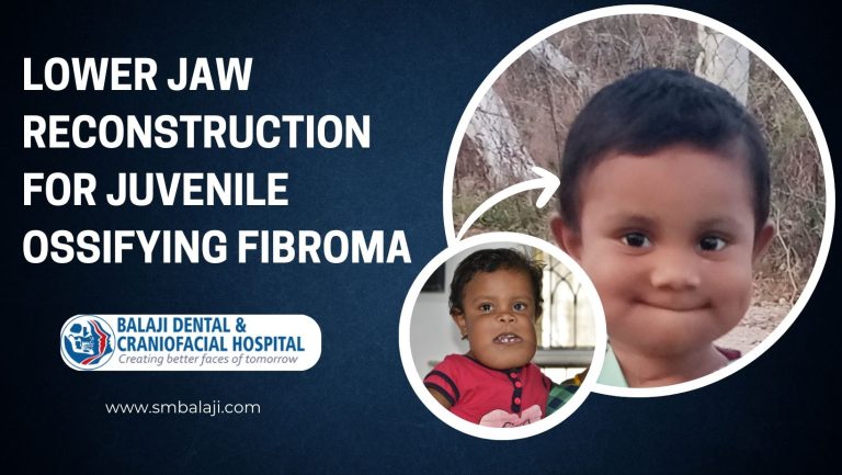 Lower Jaw Reconstruction for Juvenile Ossifying Fibroma