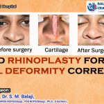 Closed Rhinoplasty For Cleft Nasal Deformity Correction