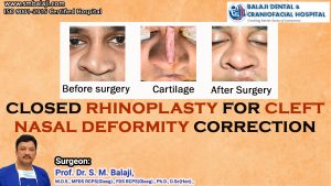 Closed Rhinoplasty for Cleft Nasal Deformity Correction