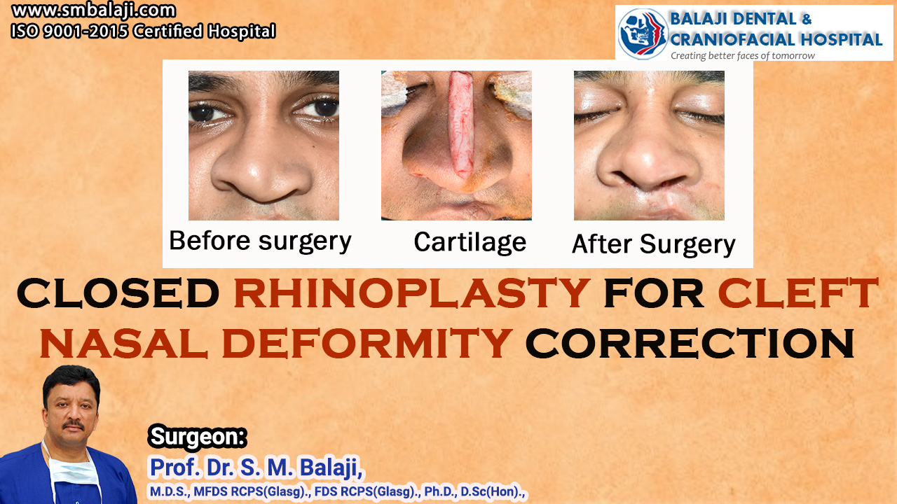 Closed Rhinoplasty for Cleft Nasal Deformity Correction