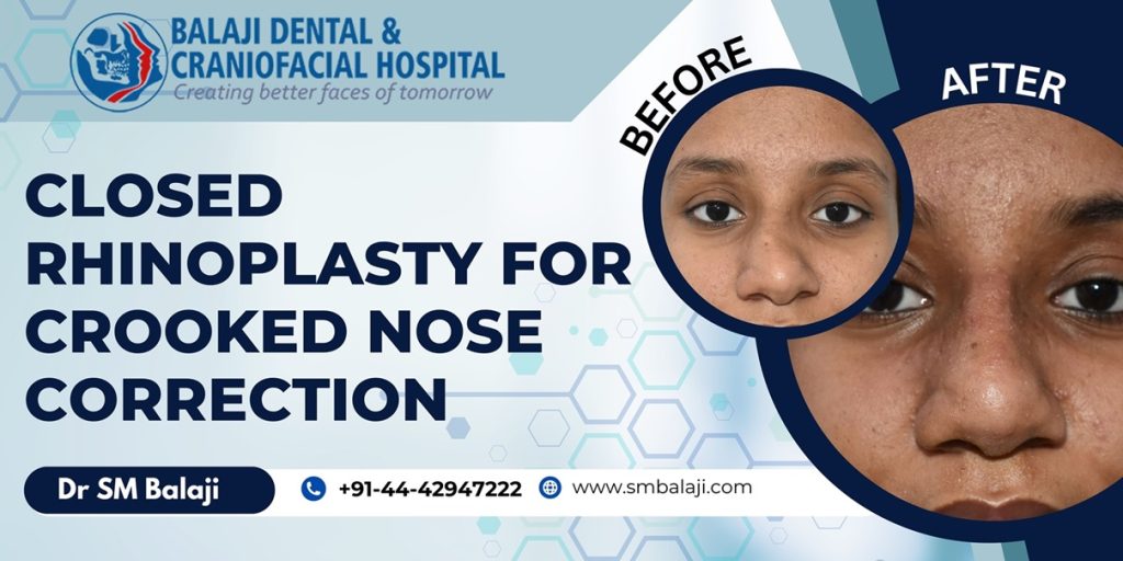 Closed Rhinoplasty For Crooked Nose Correction