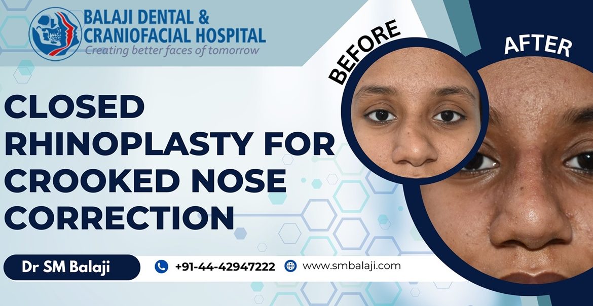 Closed Rhinoplasty For Crooked Nose Correction