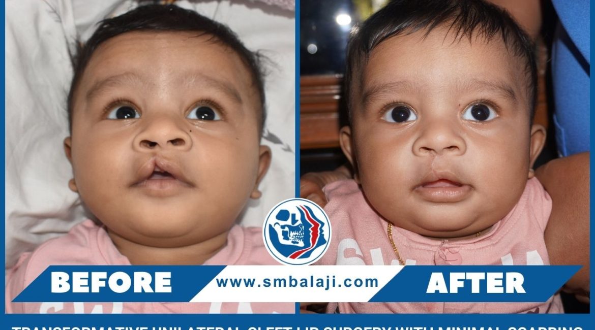 Transformative Unilateral Cleft Lip Surgery With Minimal Scarring