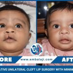 Transformative Unilateral Cleft Lip Surgery With Minimal Scarring