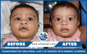 Surgical Correction Of A Wide Tessiers Midline Cleft Lip Defect