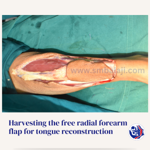 Harvesting The Free Radial Forearm Flap For Tongue Reconstruction