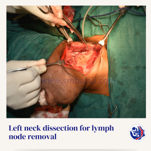 Left Neck Dissection For Lymph Node Removal