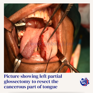 Picture Showing Left Partial Glossectomy To Resect The Cancerous Part Of Tongue