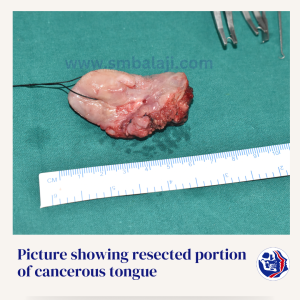 Picture Showing Resected Portion Of Cancerous Tongue