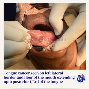 Tongue Cancer Seen On Left Lateral Border And Floor Of The Mouth Extending Upto Posterior 13Rd Of The Tongue