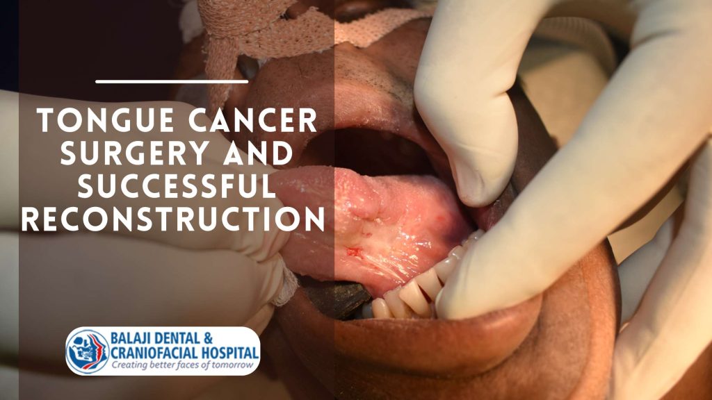 Tongue Cancer Surgery And Successful Reconstruction At Balaji Dental &Amp; Craniofacial Hospital, India.