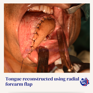 Tongue Reconstructed Using Radial Forearm Flap